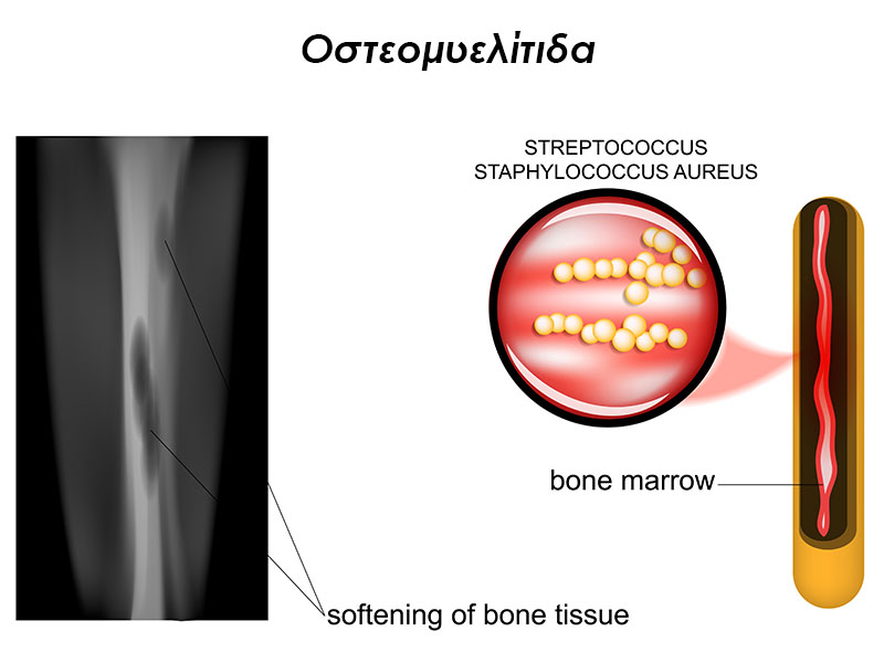 οστεομυελίτιδα