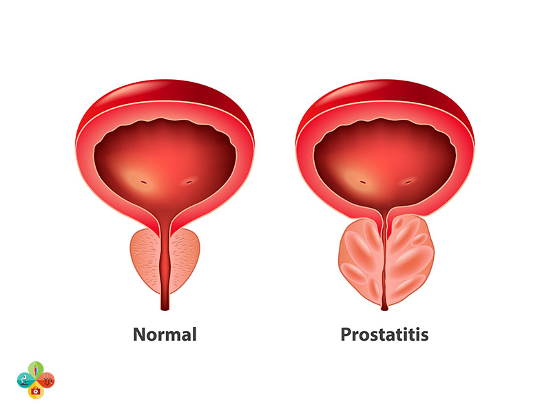 προστατίτιδα