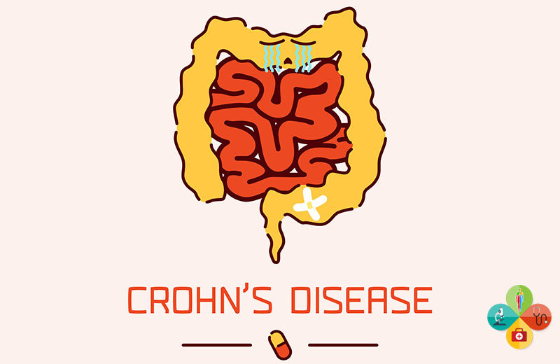 νόσος Crohn